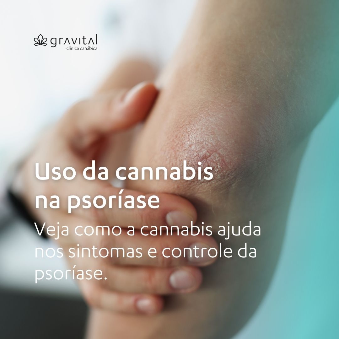 Cannabis e psioriase